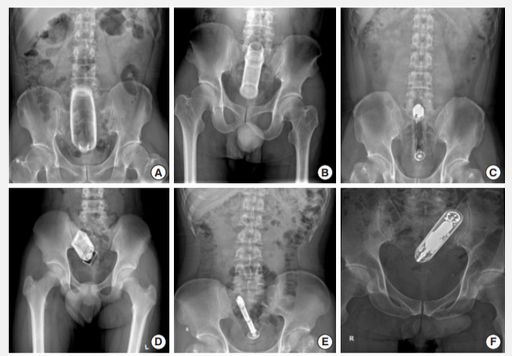 アナルから大人のおもちゃが抜けない！肛門性交や自慰で起こる「直腸異物」とは？
